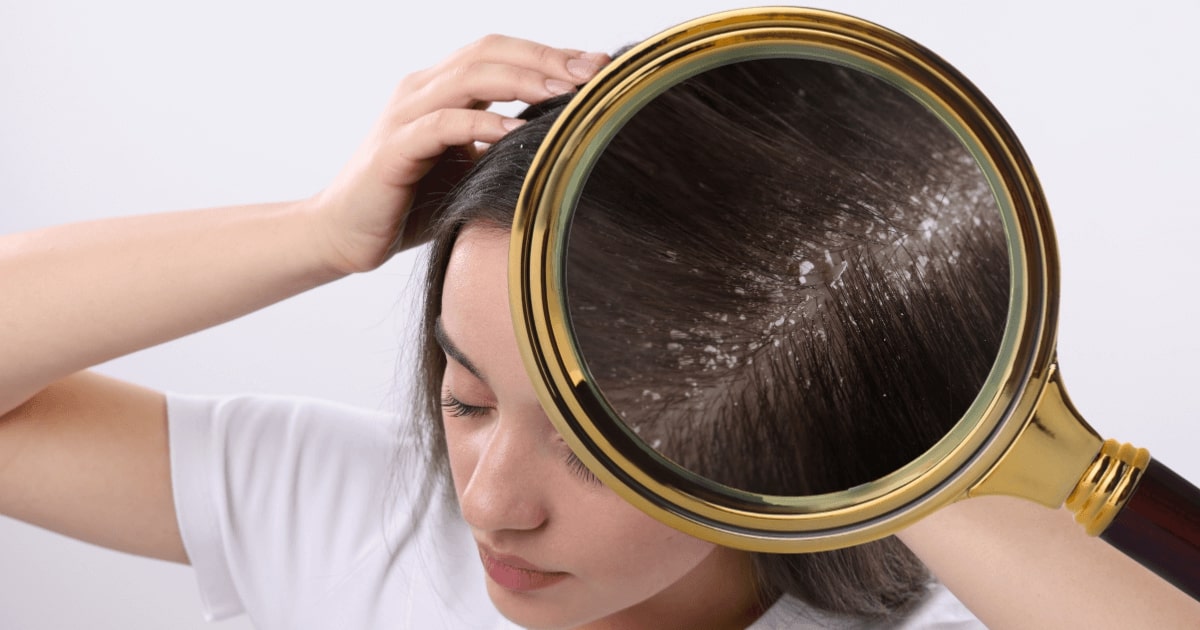 Najczęstsze choroby włosów i skóry głowy – jak je rozpoznać i leczyć - obrazek wyróżnijący