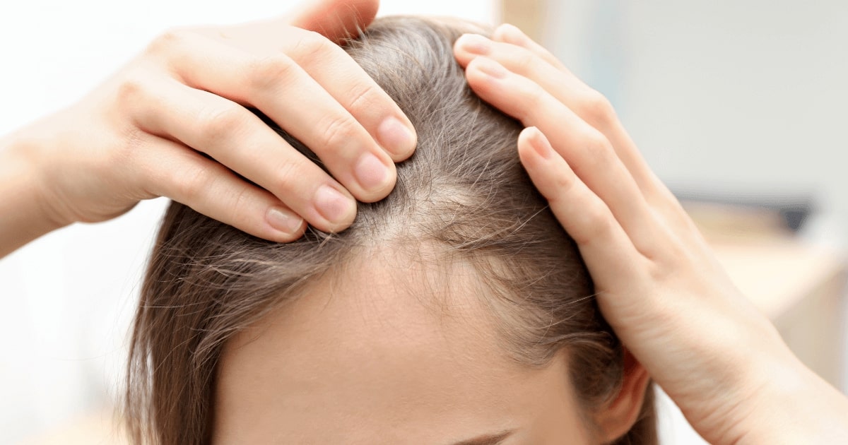Kobieta odsłaniająca przedziałek, pokazująca przerzedzone włosy i objawy problemów skóry głowy.