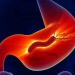 Dieta przy Helicobacter pylori–co warto wiedzieć - obrazek wyróżniający