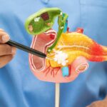 Dieta trzustkowa – jak jeść, by odciążyć trzustkę i złagodzić objawy? - obrazek wyróżniający