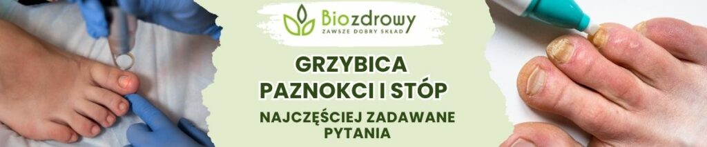 Grzybica paznokci i stóp FAQ - obrazek poglądowy