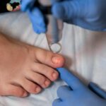 Jak rozpoznać i leczyć grzybicę paznokci oraz stóp? - obrazek wyróżniający