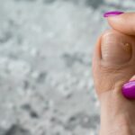Onycholiza paznokci – objawy, przyczyny i sposoby leczenia - obrazek wyróżniający