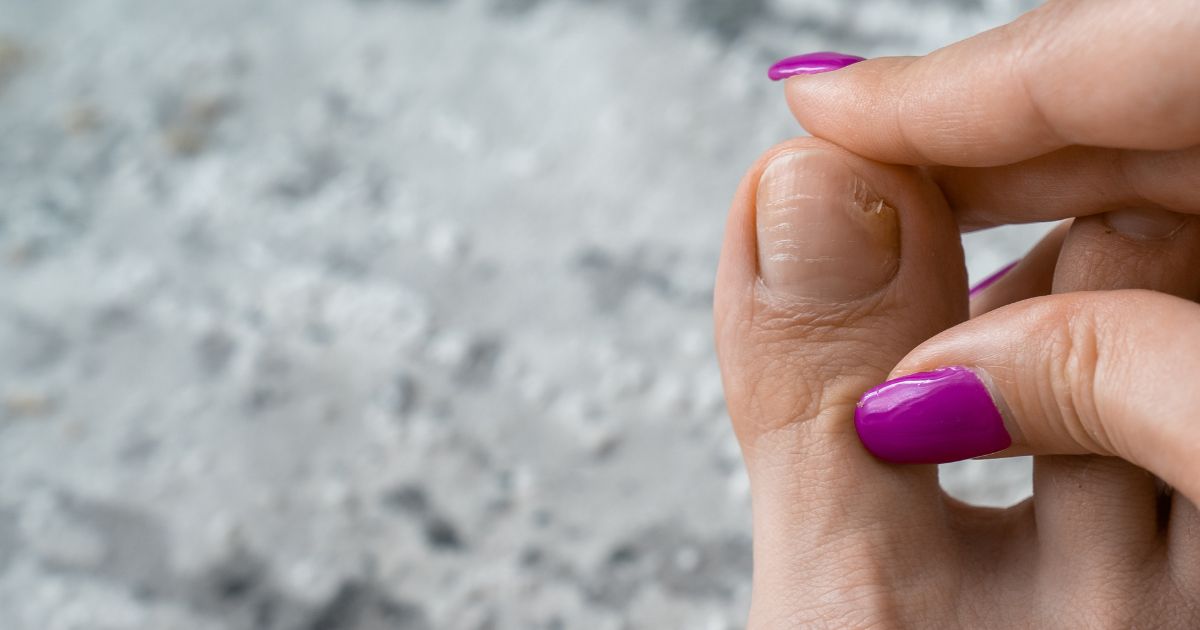 Onycholiza paznokci – objawy, przyczyny i sposoby leczenia - obrazek wyróżniający