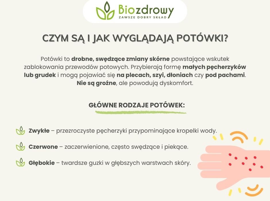 Czym są i jak wyglądają potówki - infografika