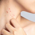 Potówki–czym są, jak je rozpoznać i leczyć - obrazek wyróżniający