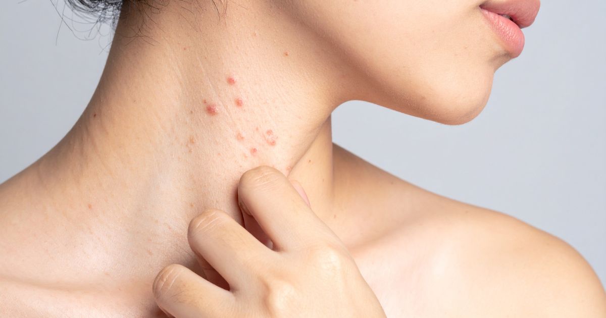 Potówki–czym są, jak je rozpoznać i leczyć - obrazek wyróżniający