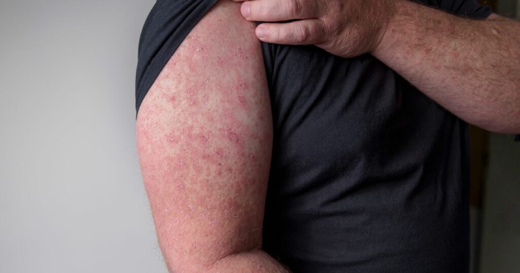 Róża (choroba skóry)–charakterystyka, diagnostyka i leczenie - obrazek wyróżniający