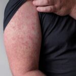 Róża (choroba skóry)–charakterystyka, diagnostyka i leczenie - obrazek wyróżniający