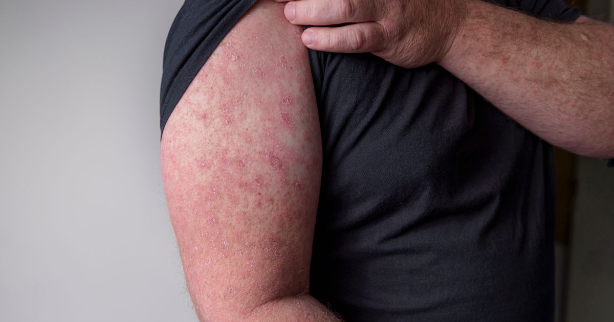 Róża (choroba skóry)–charakterystyka, diagnostyka i leczenie - obrazek wyróżniający