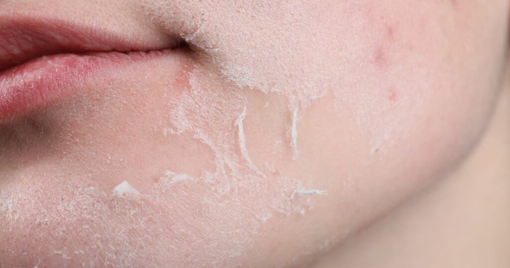 Sucha skóra–skąd się bierze i jak sobie z nią radzić - obrazek wyróżniający