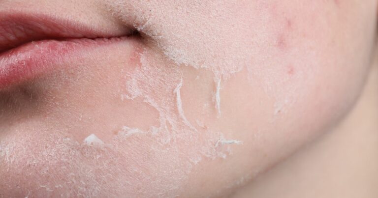 Sucha skóra–skąd się bierze i jak sobie z nią radzić - obrazek wyróżniający