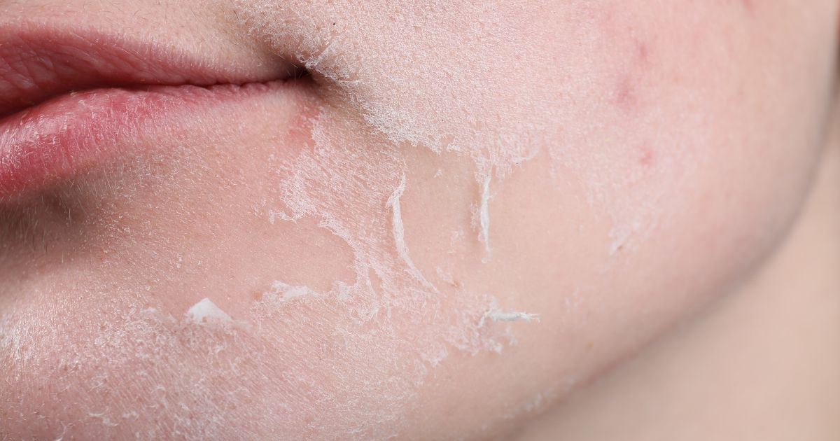 Sucha skóra–skąd się bierze i jak sobie z nią radzić - obrazek wyróżniający