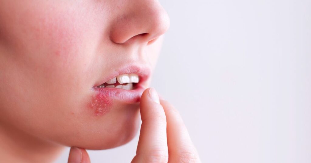 Lizyna na opryszczkę - zdjęcie poglądowe