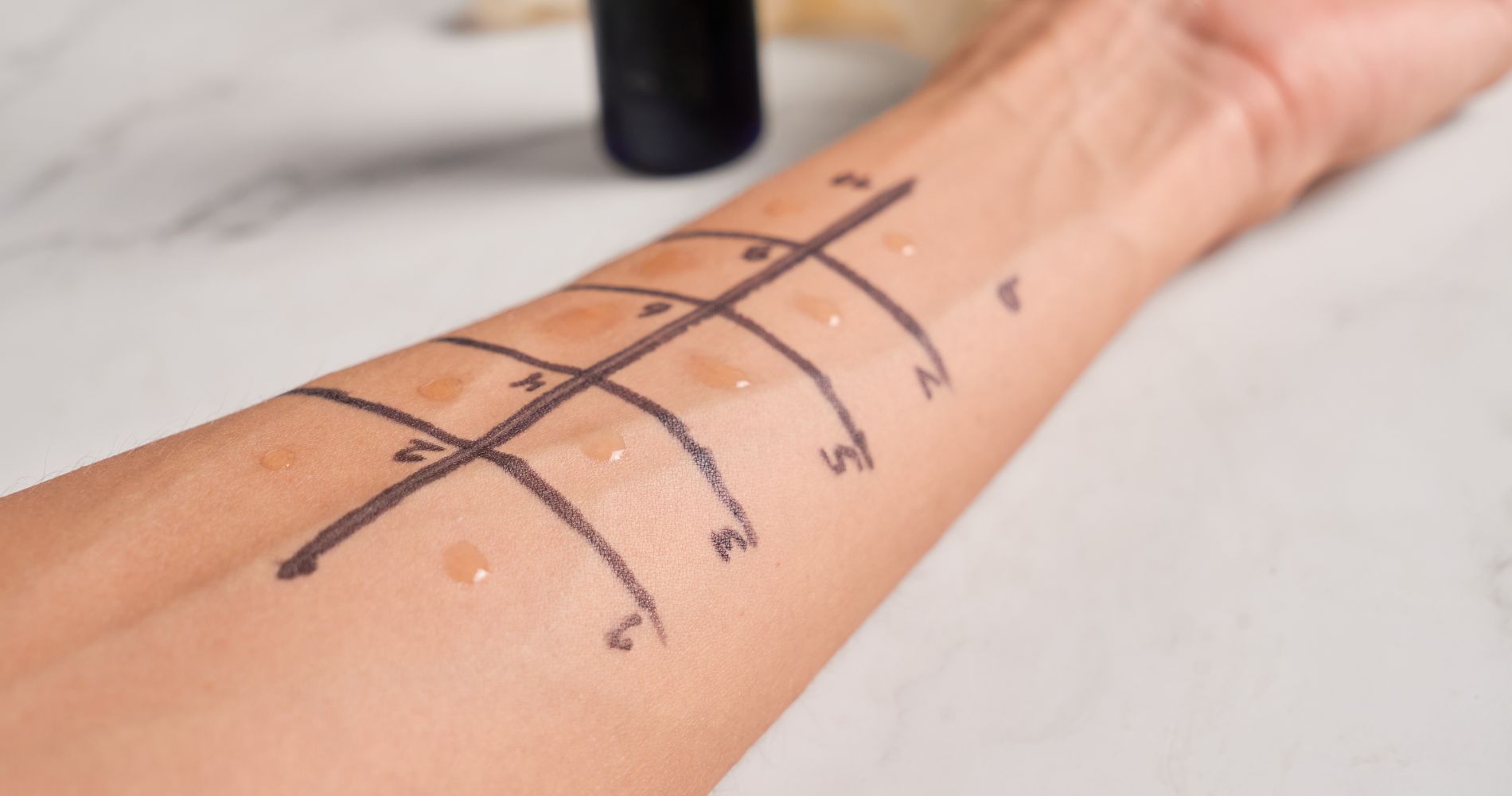 Testy skórne alergiczne na przedramieniu – diagnostyka alergii.