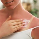 Oparzenia słoneczne – jak pomóc skórze wrócić do równowagi?  - obrazek wyróżniający
